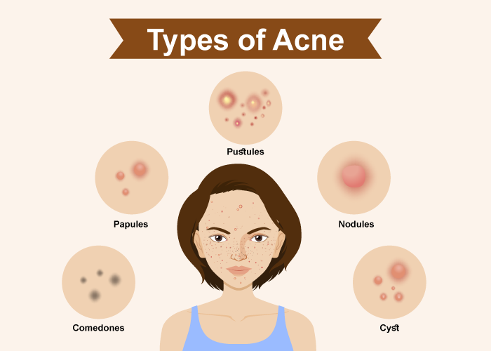 Types of Acne - Remedyspace