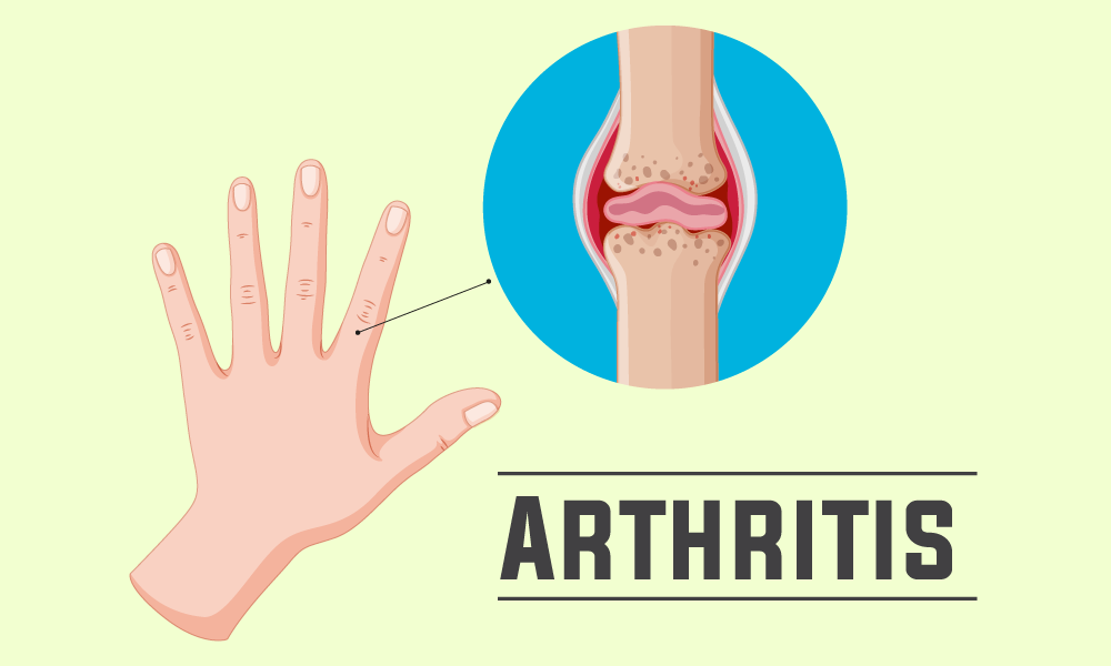 Complete Guide to Arthritis - Remedyspace