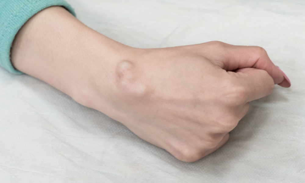 A Complete Guide to Ganglion Cysts